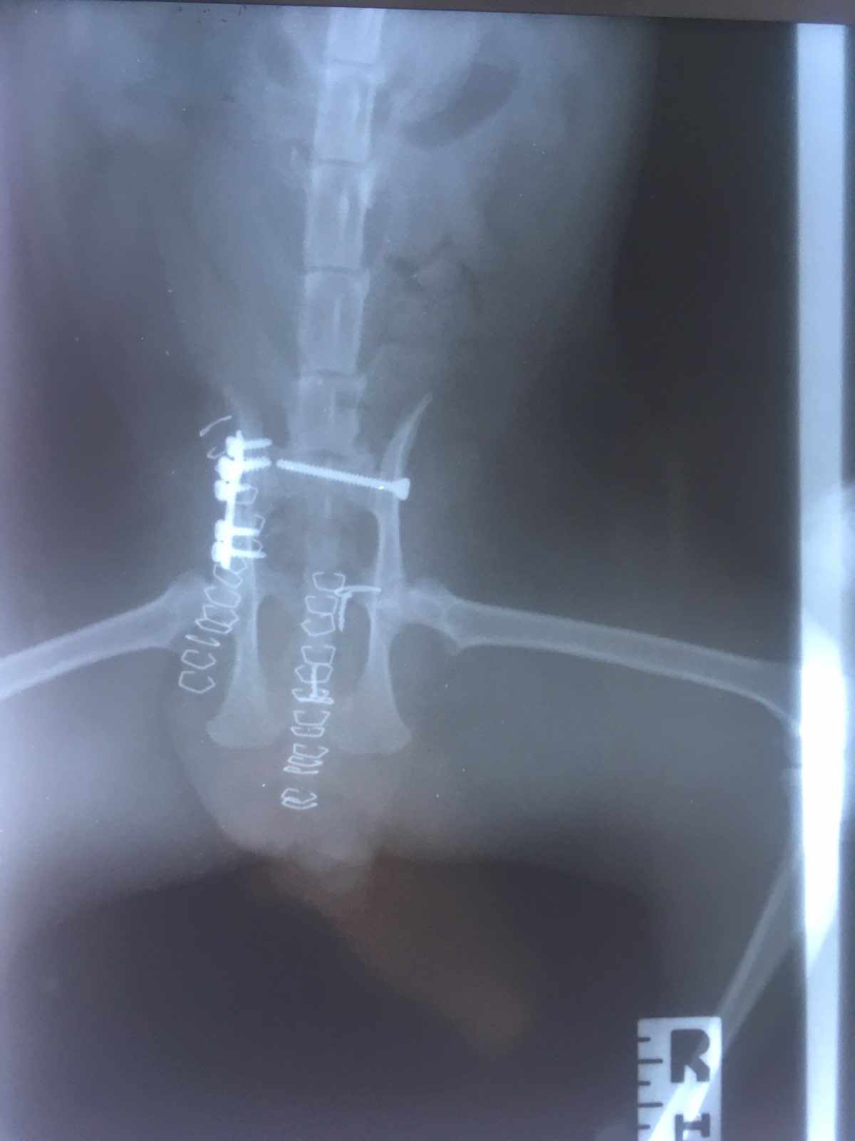 Nari – rentgen po operaci pánve